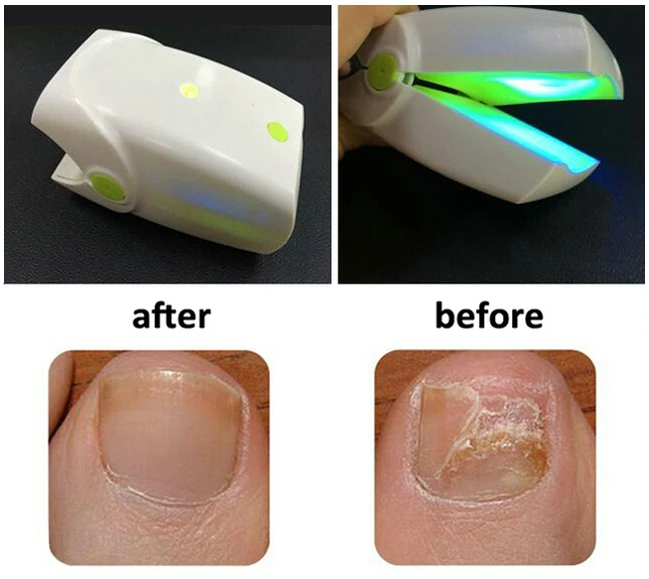 OFERTA! Scapa de ciuperca unghiilor - Onicomicoza cu Laser sau IPL - Reduceri Doctori