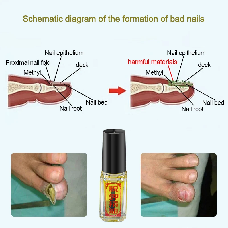 medicament pentru drojdia unghiilor de la picioare ciuperca unghiilor conform mcb 10